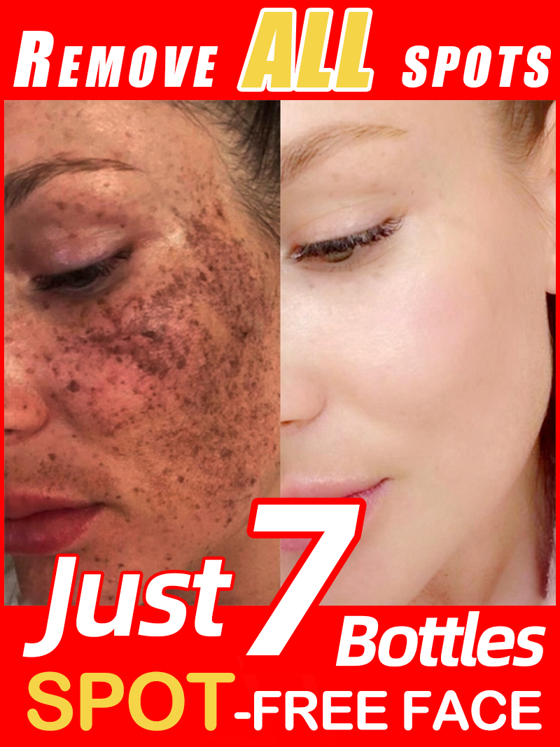 Ultra Luxury Skincare - Verlicht sproeten Melasma, donkere gezichtsvlekken